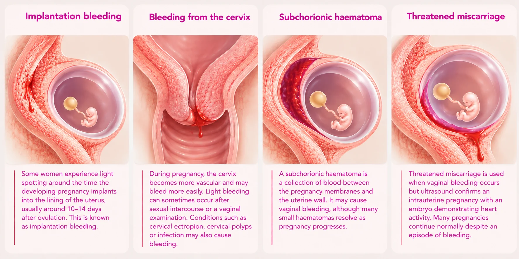 Illustration of causes of bleeding in early pregnancy: implantation bleeding, bleeding from the cervix, subchorionic haematoma and threatened miscarriage