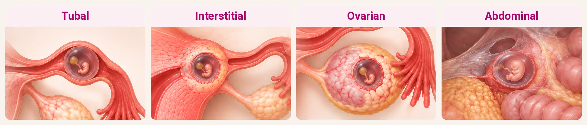 Illustration of types of ectopic pregnancy: tubal, interstitial, ovarian and abdominal ectopic pregnancy
