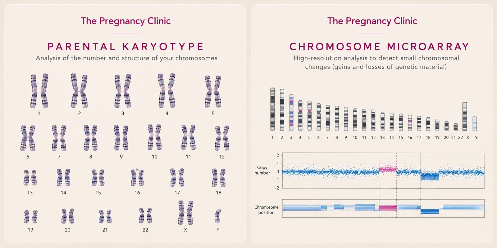 Illustrations of a parental karyotype showing chromosome pairs and a chromosome microarray showing gains and losses of genetic material