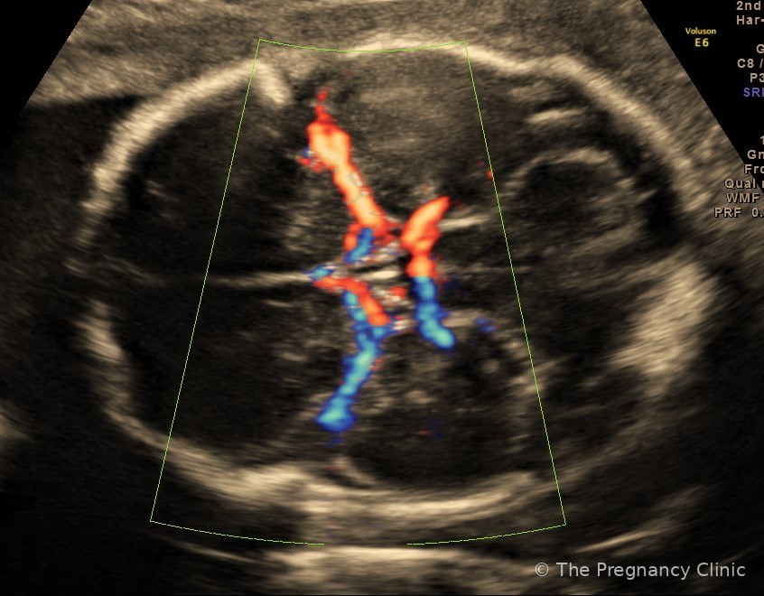 Colour Doppler of the baby’s brain showing the middle cerebral arteries at a third-trimester growth scan