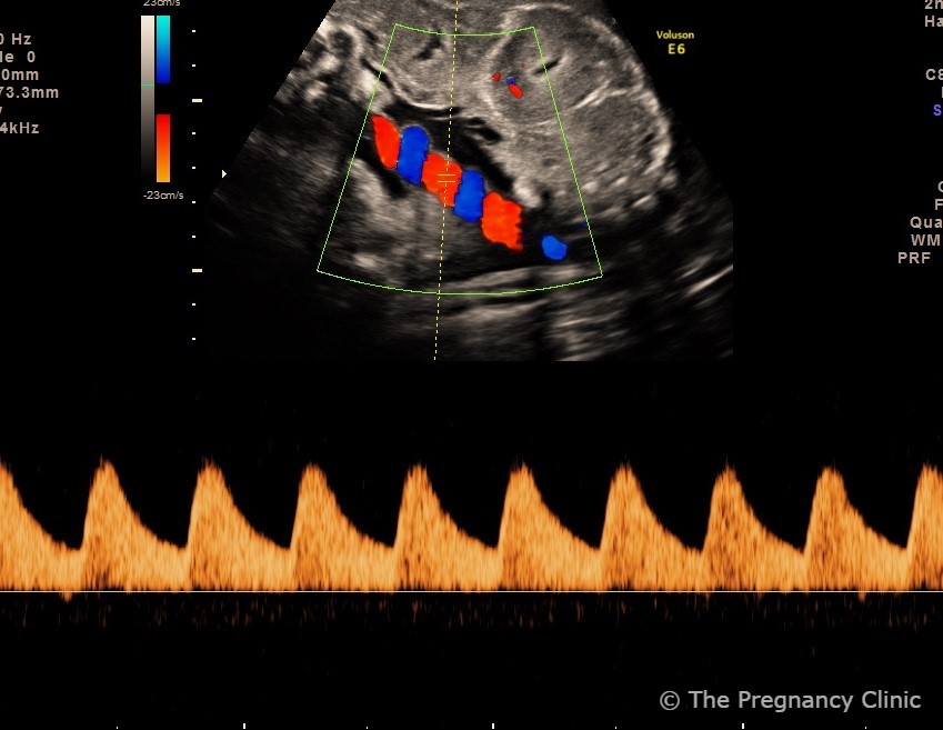 Umbilical artery Doppler waveform at a third-trimester growth scan