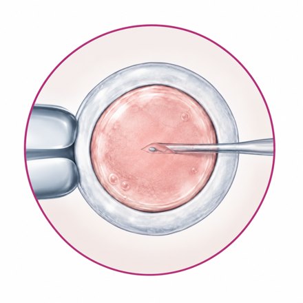ICSI intracytoplasmic sperm injection illustration