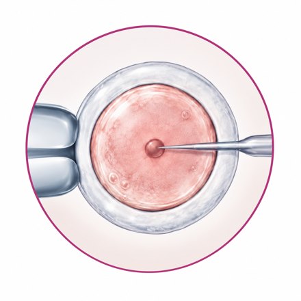IVF in vitro fertilisation illustration