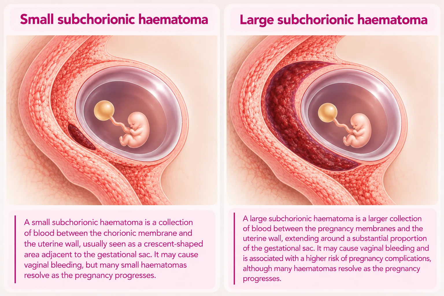 Illustration comparing a small subchorionic haematoma beside the pregnancy sac with a large subchorionic haematoma extending around much of the sac